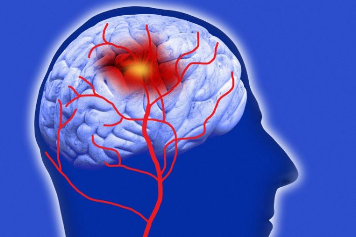Những thông tin cho tiết về bệnh tai biến mạch máu não
